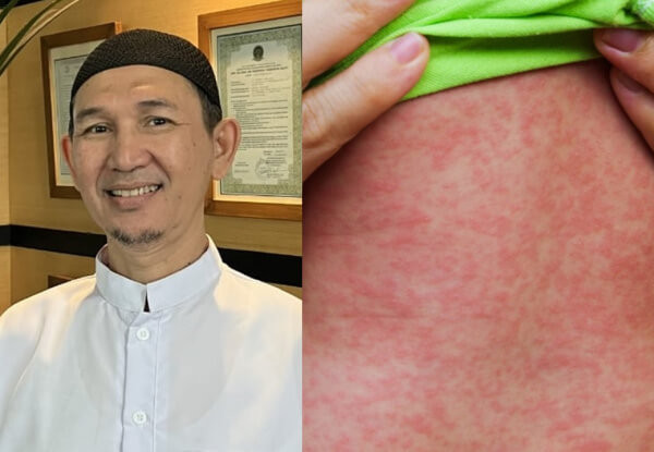 Kesehatan : Sakit Campak Pada Anak Ini Formula Herbal dari dr Fardinan Rabain